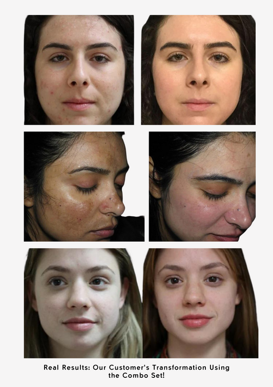 The Ordinary Set for Melasma, Pigmentation, and Dark Spots Gone! - Sunscreen for acne - view 2
