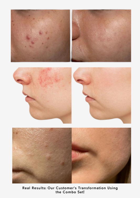 The Ordinary Set for Oily, Acne-Prone Skin - Sunscreen for acne - view 2