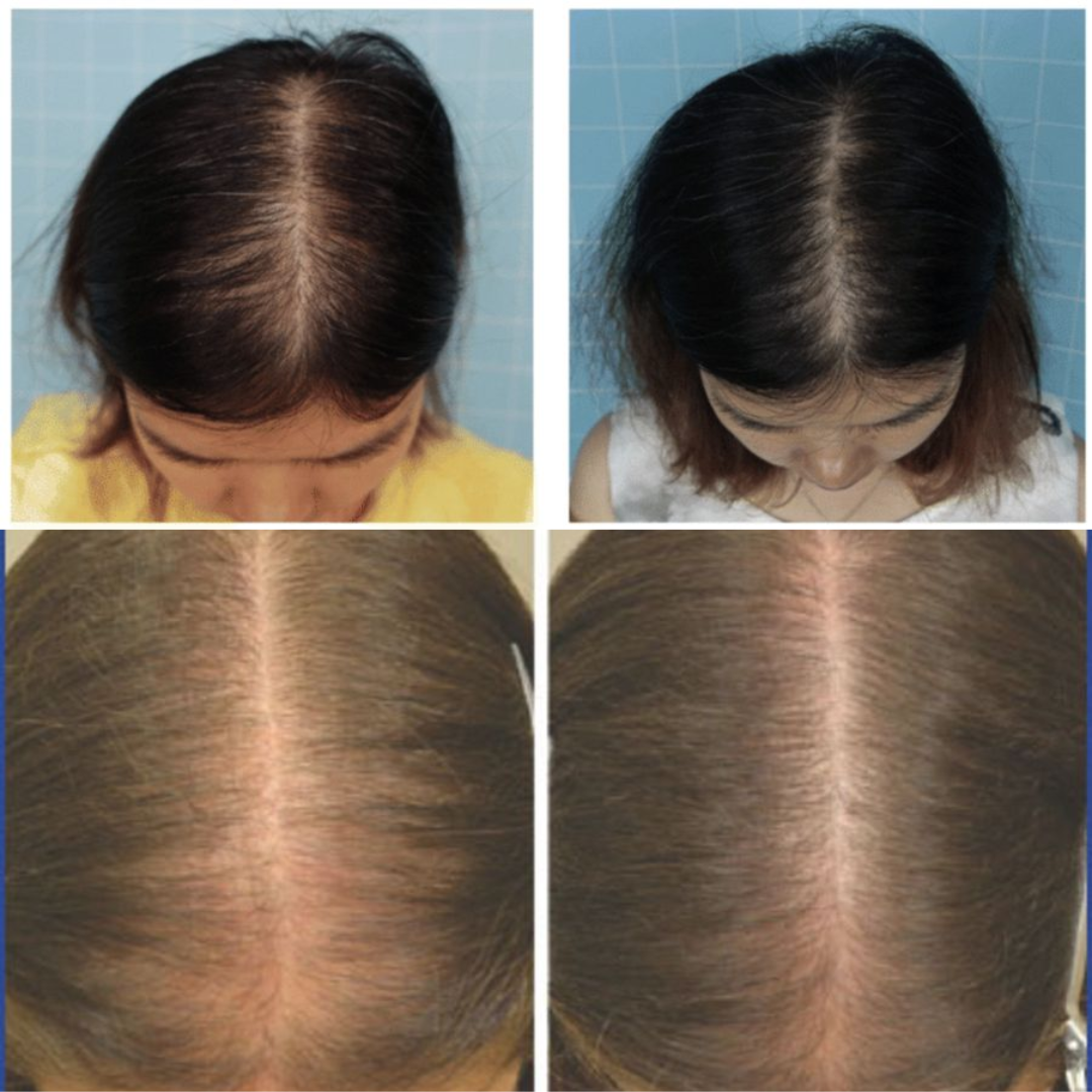 Rogaine for Women - Hair Regrowth 5% Minoxidil Foam 2 Month Supply - Modarak Qatar