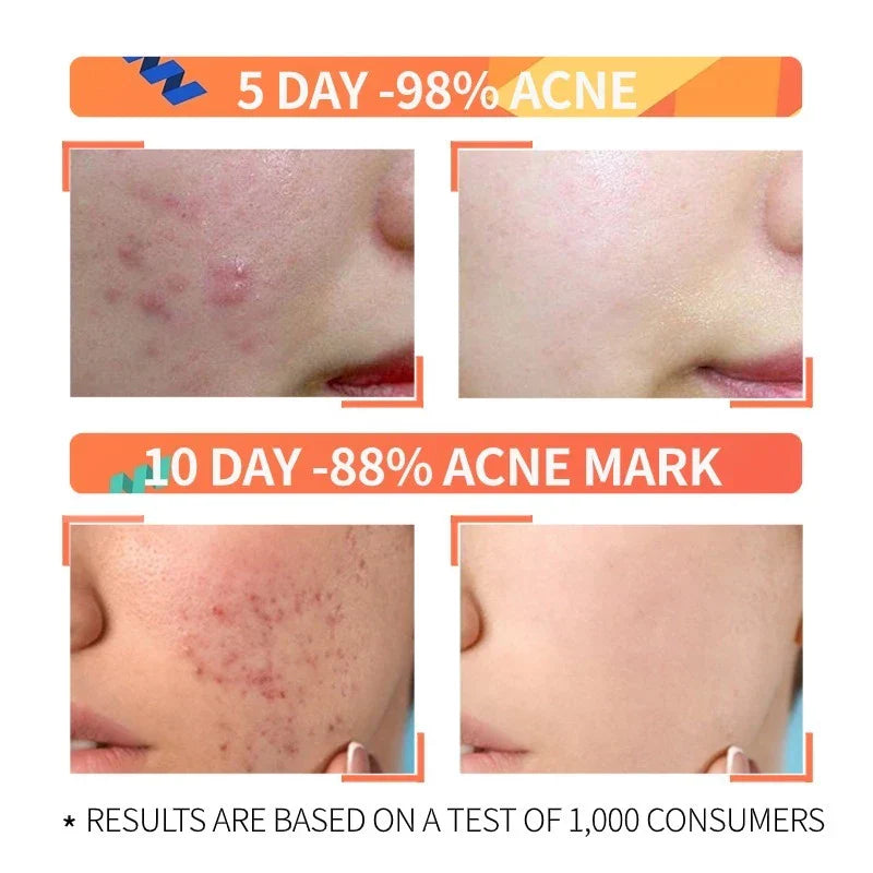 The Ordinary Niacinamide + Glycolic Acid Duo - Sunscreen for acne - view 9