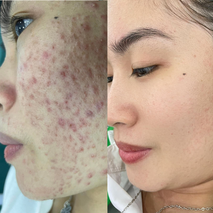 The Ordinary Set for Oily, Acne-Prone Skin - Sunscreen for acne - view 3