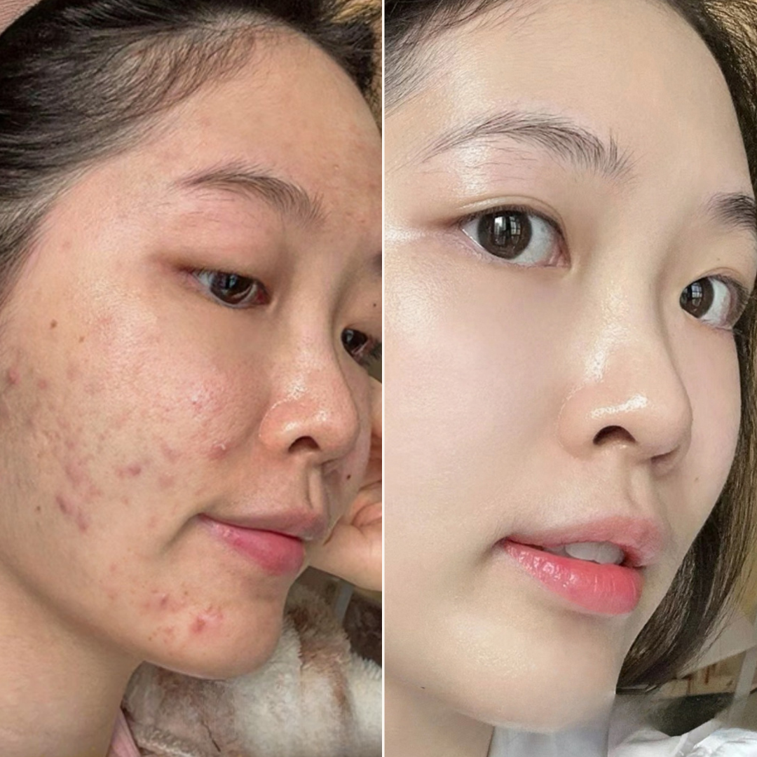 The Ordinary Set for Oily, Acne-Prone Skin - Sunscreen for acne - view 4