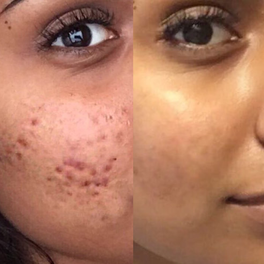 The Ordinary Set for Oily, Acne-Prone Skin - Sunscreen for acne - view 5