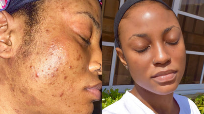 The Ordinary Set for Oily, Acne-Prone Skin - Sunscreen for acne - view 6