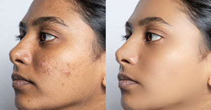 The Ordinary Set for Oily, Acne-Prone Skin - Sunscreen for acne - view 7