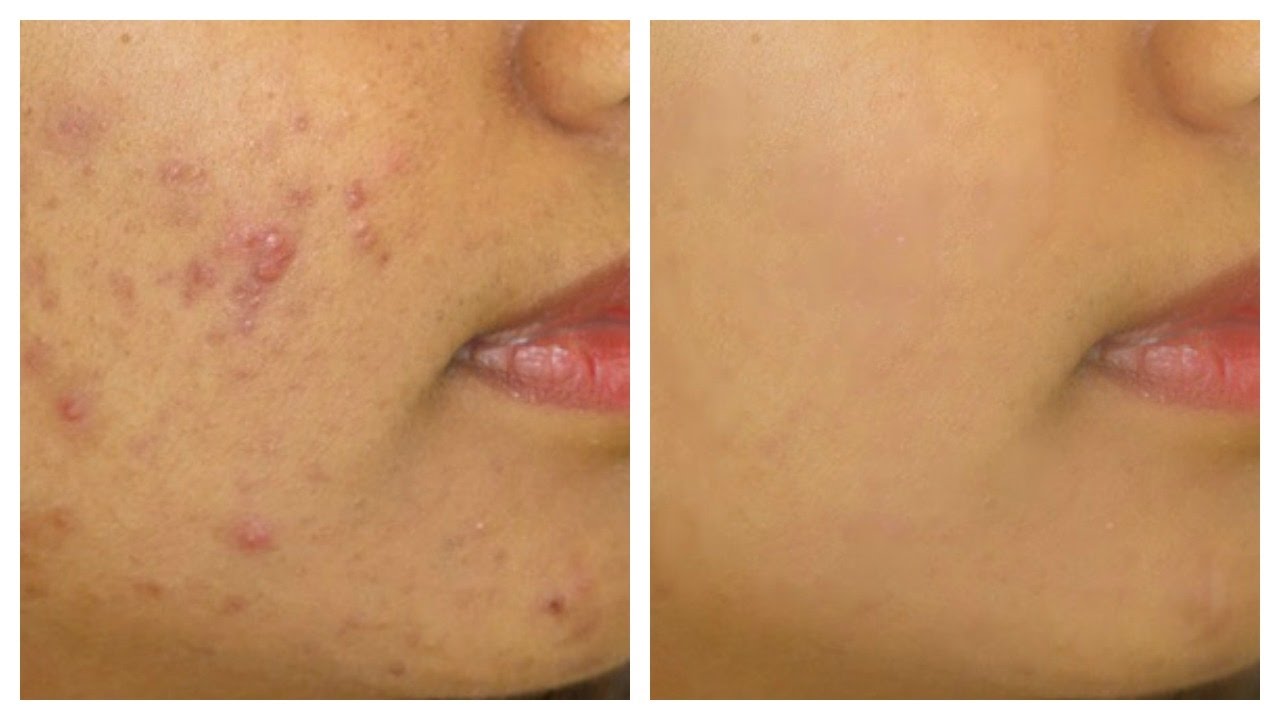 The Ordinary Set for Oily, Acne-Prone Skin - Sunscreen for acne - view 8